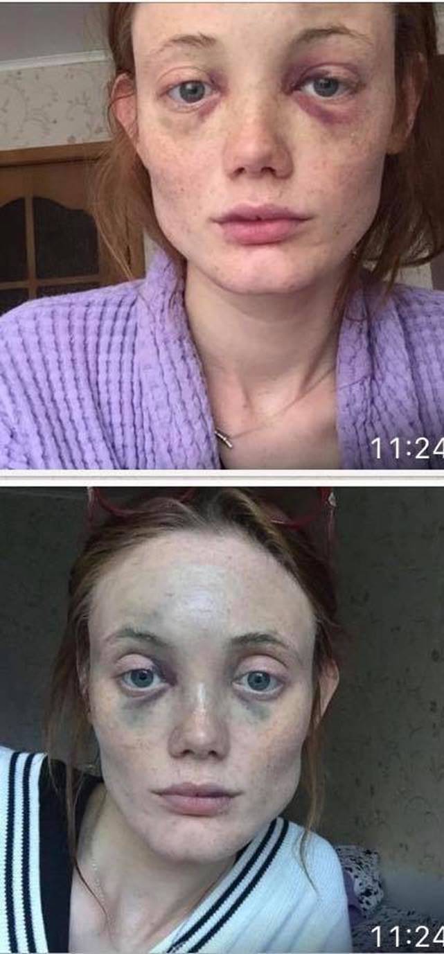 Người mẫu Vouge tố bạn trai cũ bạo hành dã man: Bị cưỡng bức, nuốt tiền giấy và ném ghế vào mặt-5