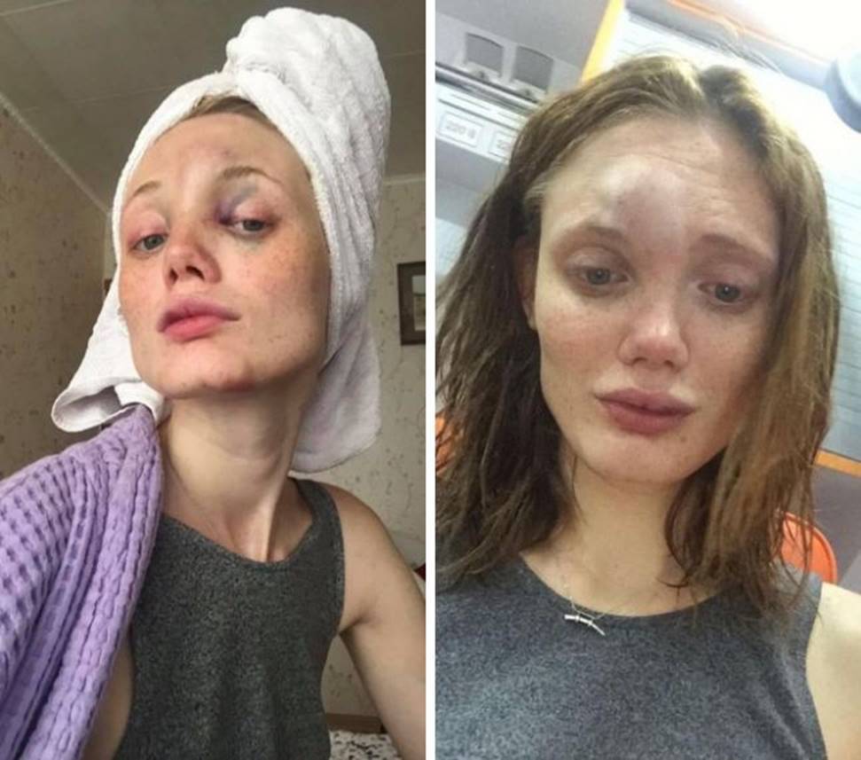 Người mẫu Vouge tố bạn trai cũ bạo hành dã man: Bị cưỡng bức, nuốt tiền giấy và ném ghế vào mặt-7