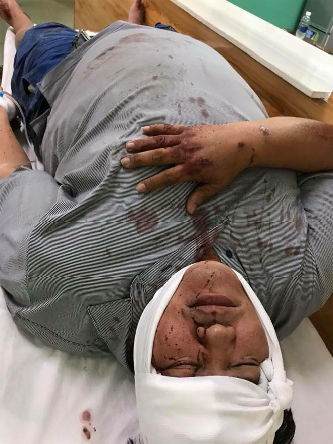 Hoàng Mập đi cấp cứu sau chấn thương vì bị kẻ lạ tông xe rồi bỏ trốn-2