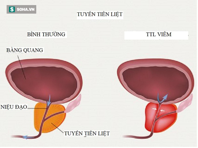 Bác sĩ cảnh báo sớm 5 triệu chứng viêm tuyến tiền liệt: Nếu ai thấy giống là phải đi khám-2