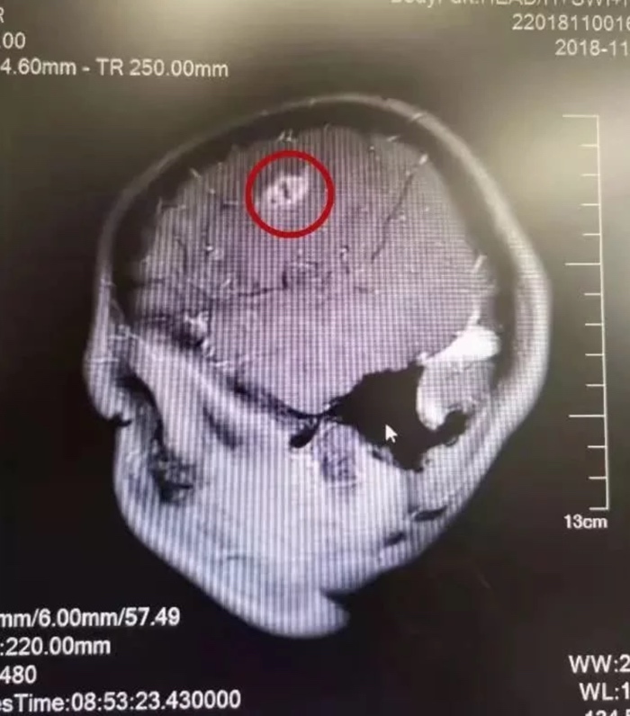 Bác sĩ lôi ký sinh trùng 15cm trong não bé trai, cảnh báo thói quen xấu khi ăn uống-2