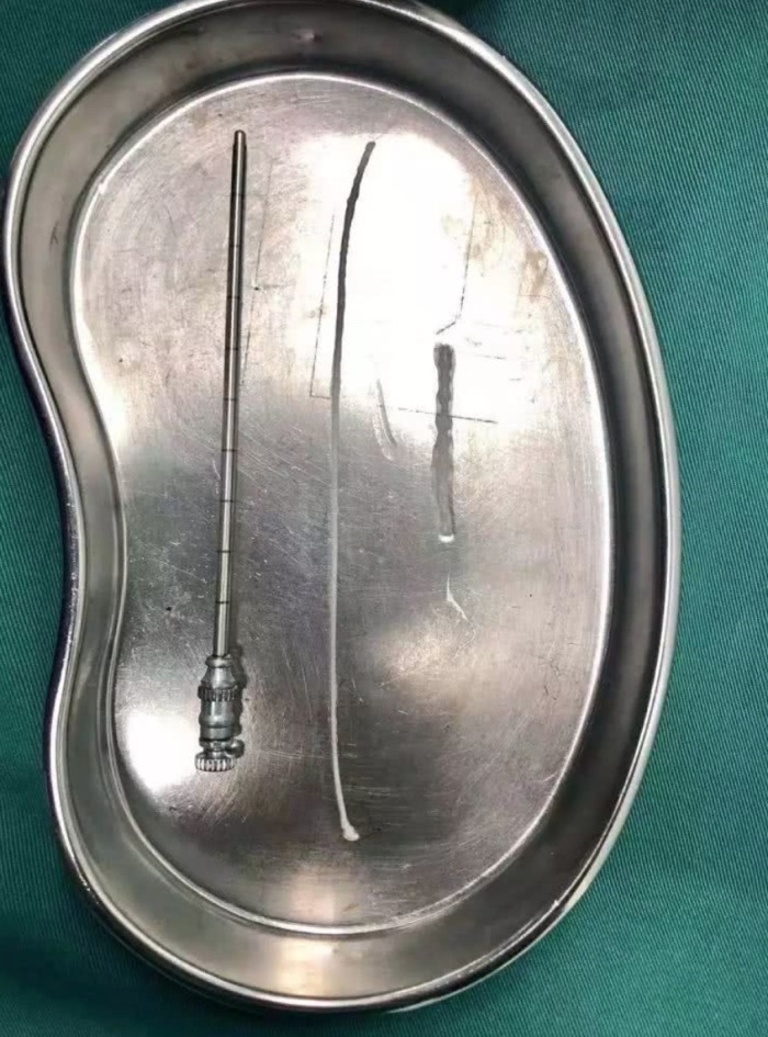 Bác sĩ lôi ký sinh trùng 15cm trong não bé trai, cảnh báo thói quen xấu khi ăn uống-3