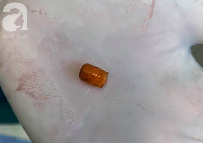 Long An: Ném cát đùa giỡn với bạn, bé trai 6 tuổi hít phải miếng nhựa vào mũi gây xẹp phổi nguy kịch-4