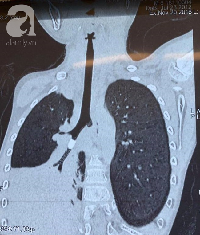 Long An: Ném cát đùa giỡn với bạn, bé trai 6 tuổi hít phải miếng nhựa vào mũi gây xẹp phổi nguy kịch-2