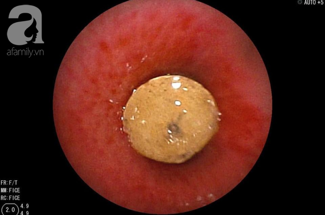 Long An: Ném cát đùa giỡn với bạn, bé trai 6 tuổi hít phải miếng nhựa vào mũi gây xẹp phổi nguy kịch-3