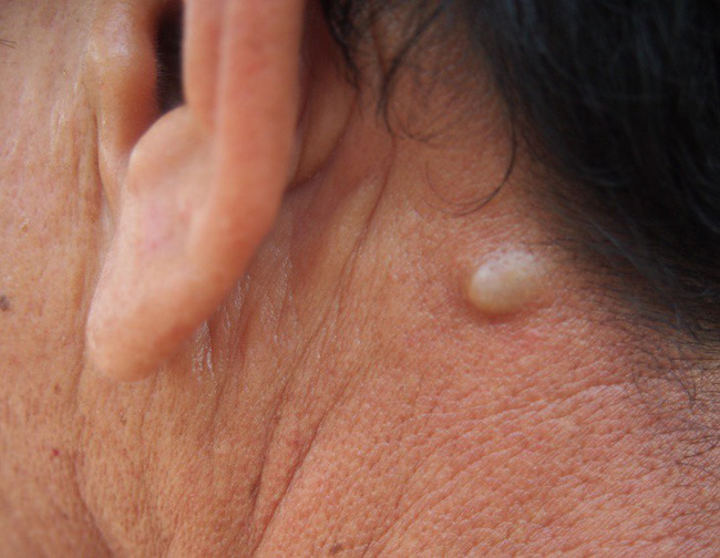 Nếu bỗng nhiên thấy sưng hoặc nổi cục ở cổ và tai, đừng bao giờ bỏ qua những khả năng này-2