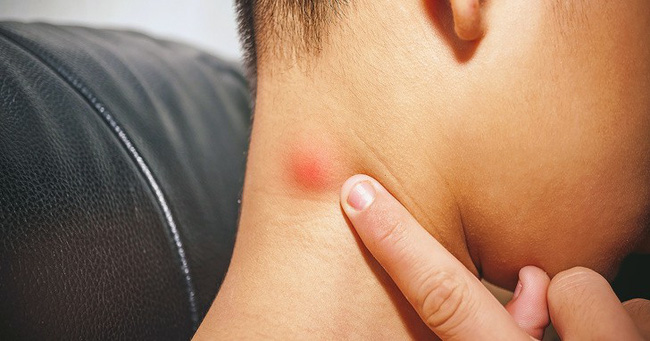 Nếu bỗng nhiên thấy sưng hoặc nổi cục ở cổ và tai, đừng bao giờ bỏ qua những khả năng này-5
