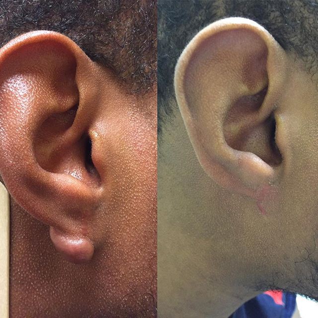 Nếu bỗng nhiên thấy sưng hoặc nổi cục ở cổ và tai, đừng bao giờ bỏ qua những khả năng này-6