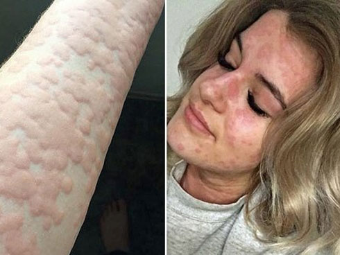 Cẩn thận kẻo trời lạnh quá sẽ khiến bạn mắc phải chứng dị ứng có thể gây chết người này-4