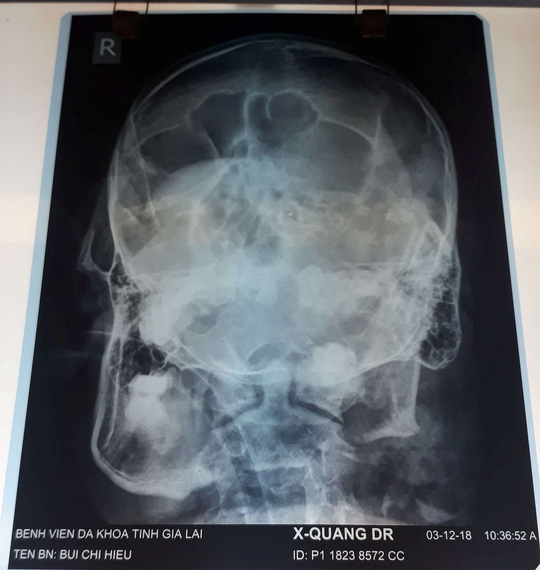 Sức khỏe phường đội phó tự sát sau khi bắn chết phó chủ tịch HĐND phường đã ổn định-2