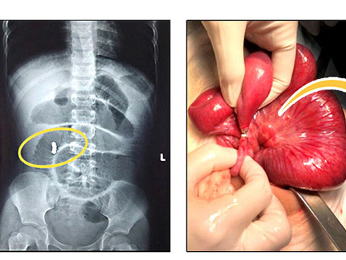 Nghệ An: Bé trai nuốt phải 25 viên bi nam châm vào ổ bụng-3