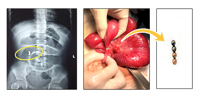 Bác sĩ cảnh báo: Viên bi nam châm đồ chơi cho trẻ em hiểm họa khôn lường-1