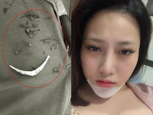 Cô gái trẻ phải tháo độn cằm vì biến chứng do tiêm chất làm đầy từ 4 năm trước