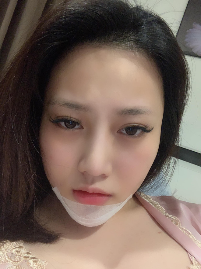 Cô gái trẻ phải tháo độn cằm vì biến chứng do tiêm chất làm đầy từ 4 năm trước-4