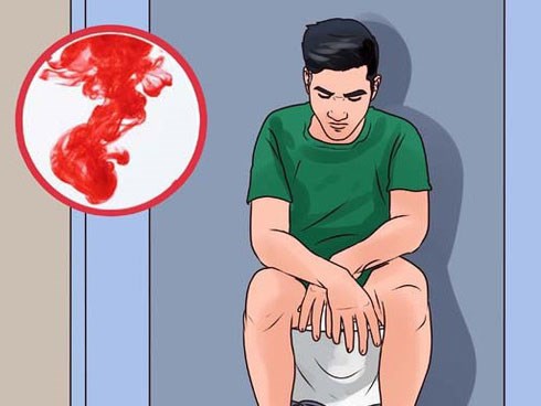Có thể bạn đã mắc bệnh ung thư trực tràng nếu gặp phải một trong 5 triệu chứng bất thường sau