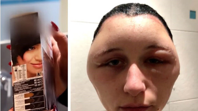 Có chị em biến dạng đầu, xơ gan chỉ vì nhuộm tóc, chuyên gia đưa ra nguyên tắc sống còn để tránh gặp họa-1