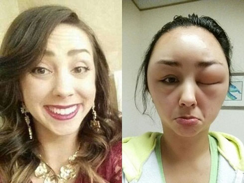 Mẹ trẻ bị xơ gan, bận nuôi con nhỏ không đi chữa, 2 năm sau khám lại thì gan đã vữa-4