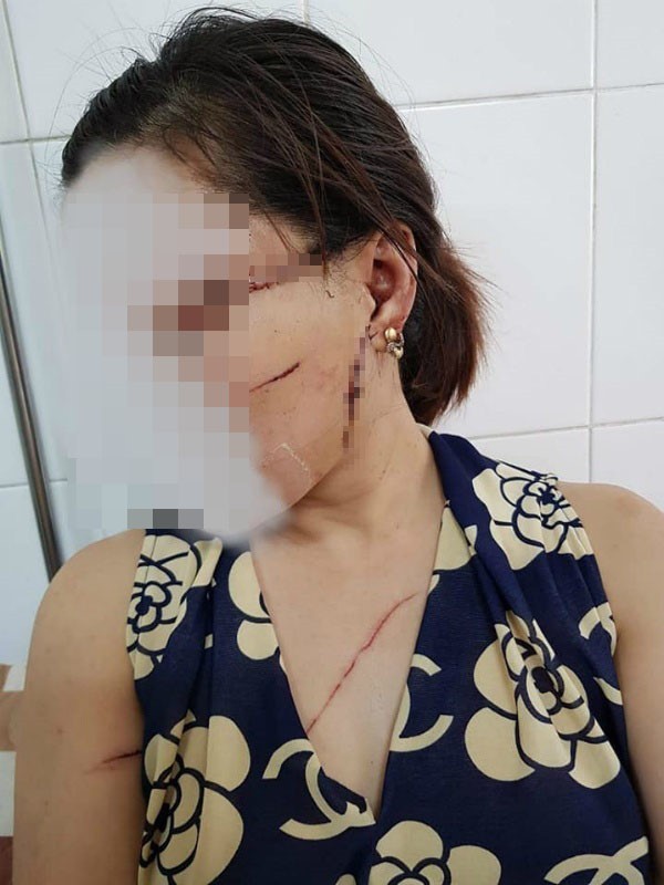 Gã chồng cắt gân chân vợ do ghen tuông lĩnh 27 tháng tù-1