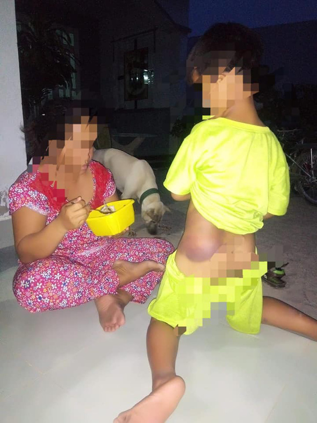 Bé trai khuyết tật học lớp 1 bị cô giáo đánh bầm tím khắp người-2