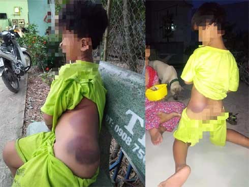 Bé trai khuyết tật học lớp 1 bị cô giáo đánh bầm tím khắp người