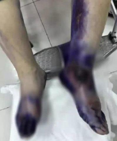 Chân người phụ nữ tím đen sau khi bị bỏng, lý giải của bác sĩ khiến nhiều người giật mình-1
