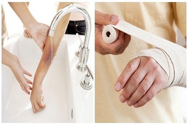 Chân người phụ nữ tím đen sau khi bị bỏng, lý giải của bác sĩ khiến nhiều người giật mình-3