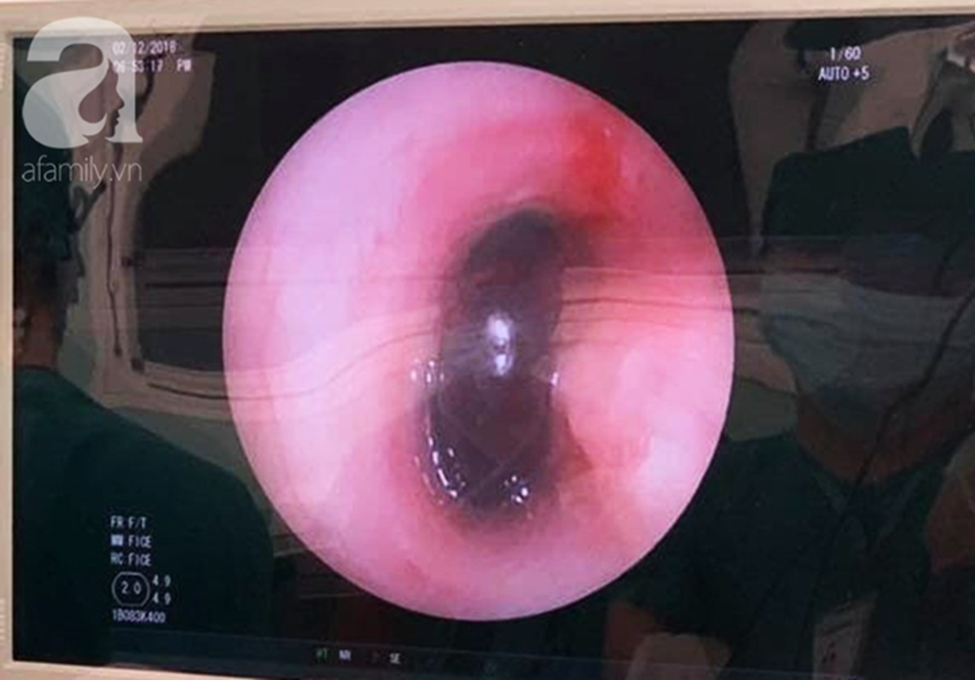 TP.HCM: Bé trai 9 tuổi bị bút chì do bạn đùa để dưới ghế đâm xuyên mông-2