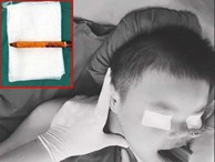 TP.HCM: Bé trai 9 tuổi bị bút chì do bạn đùa để dưới ghế đâm xuyên mông