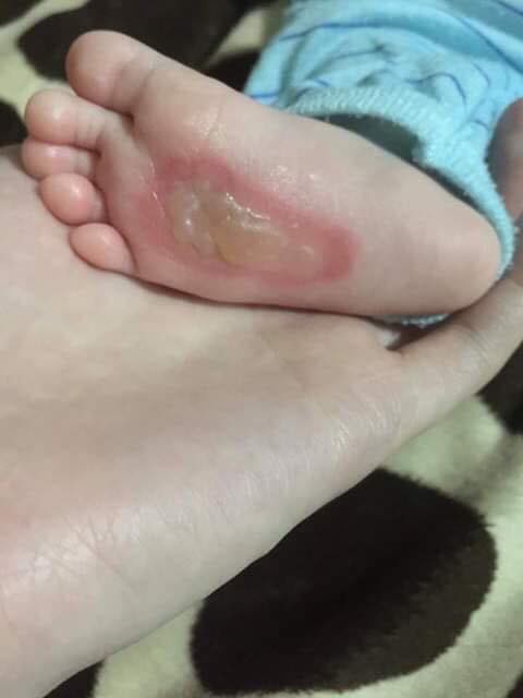 Đắp tỏi vào chân chữa ho cho con, bà mẹ tá hoả khi nhìn thấy điều này lúc cởi tất con ra-1