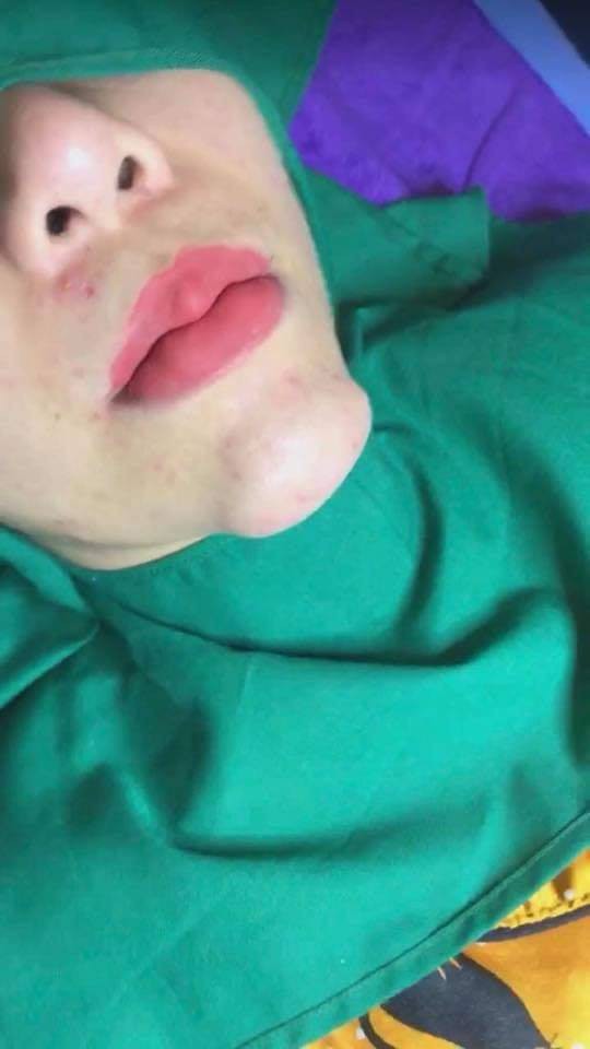 Cằm biến thành U-line sau PTTM, hình ảnh khiến nhiều người giật mình kinh hãi-1