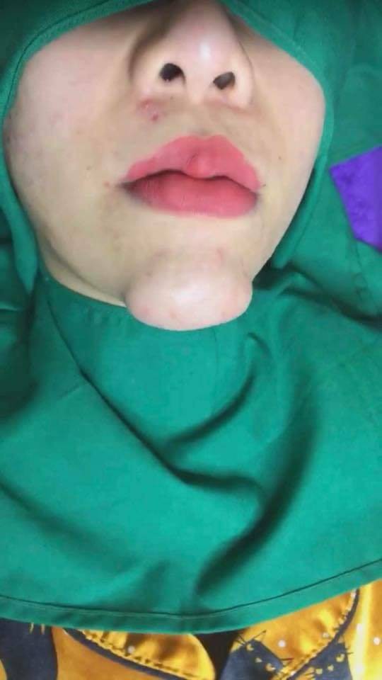 Cằm biến thành U-line sau PTTM, hình ảnh khiến nhiều người giật mình kinh hãi-2