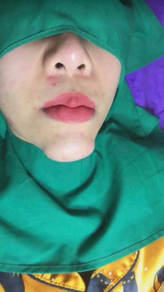 Cằm biến thành U-line sau PTTM, hình ảnh khiến nhiều người giật mình kinh hãi-3