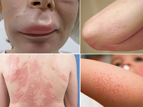 Cần làm gì để phòng tránh nguy cơ mắc chứng dị ứng cấp tính giống Hương Tràm trong thời tiết này?-9