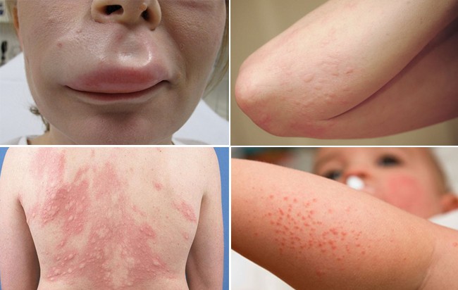 Cẩn thận kẻo trời lạnh quá sẽ khiến bạn mắc phải chứng dị ứng có thể gây chết người này-1