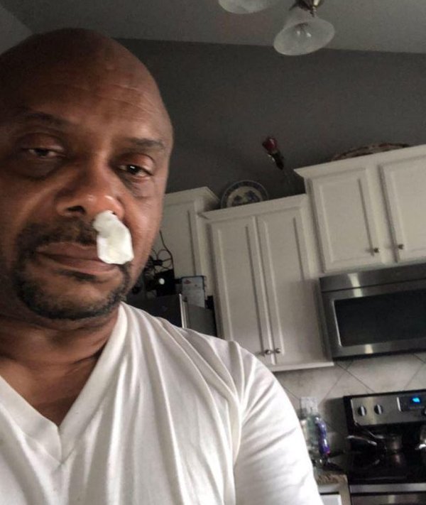 Người đàn ông tưởng cảm cúm suốt 5 năm, không ngờ chảy dịch não nguy hiểm-1