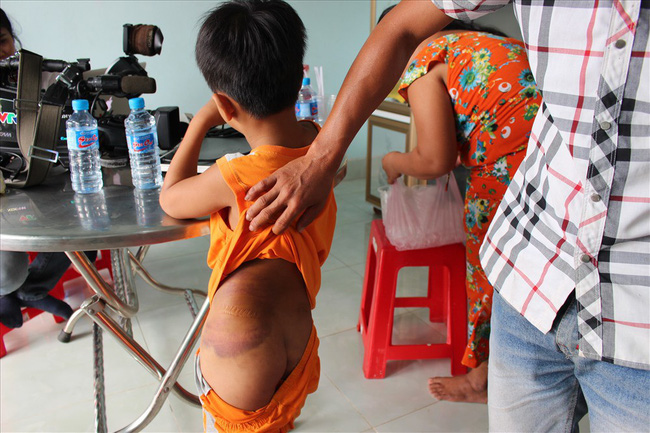 Vụ trẻ khuyết tật bị đánh: Bé muốn cô chủ nhiệm dạy thì mới đi học lại-2