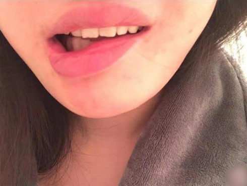 Mũi quý bà Sài Gòn cụt lủn sau nâng mũi tại thẩm mỹ viện-3