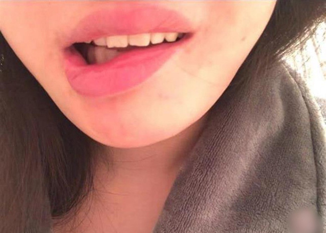 Bỏ hơn 100 triệu đi trùng tu nhan sắc, cô gái trẻ khóc ròng khi nhận về cái miệng lệch, sợ không lấy được chồng vì di chứng thẩm mỹ-1