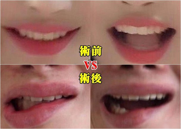 Bỏ hơn 100 triệu đi trùng tu nhan sắc, cô gái trẻ khóc ròng khi nhận về cái miệng lệch, sợ không lấy được chồng vì di chứng thẩm mỹ-2