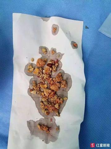 Thận đứa trẻ 5 tháng tuổi chứa đầy sỏi, vì cha mẹ cho ăn theo cách tai hại-2