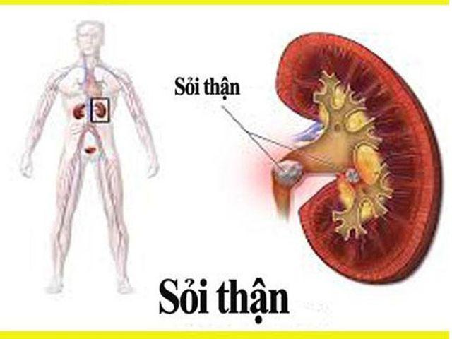 Thận đứa trẻ 5 tháng tuổi chứa đầy sỏi, vì cha mẹ cho ăn theo cách tai hại-1