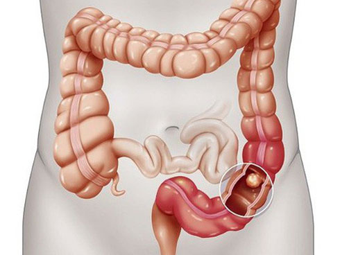 Ung thư đại trực tràng do thói quen xấu: Bạn hãy làm ngay 7 khuyến cáo sau để phòng-3
