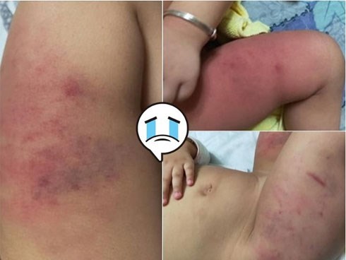 Dân mạng sục sôi truy tìm danh tính bé gái 1 tuổi nghi bị bố bạo hành đến bầm tím cơ thể