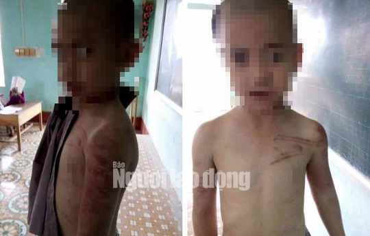 Bé trai 10 tuổi bị sư thầy bạo hành thâm tím khắp người-2