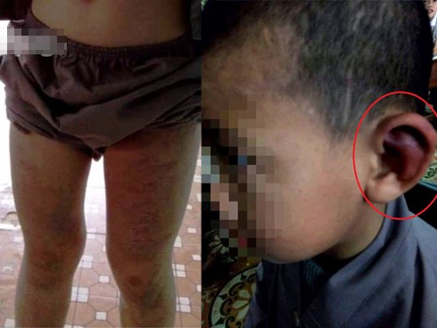 Trần tình của sư thầy bạo hành bé trai 10 tuổi thâm tím khắp người