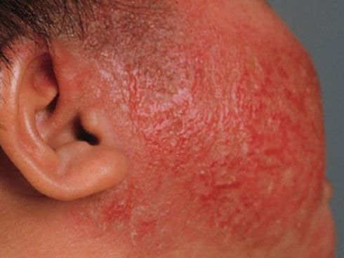 Sau khi vắt nước chanh, người phụ nữ vô tình làm điều này khiến da phồng rộp-3