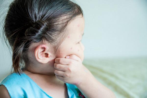 Bấn loạn khi da con đỏ như tôm luộc vì viêm da cơ địa, làm gì để con hết ngứa?-2