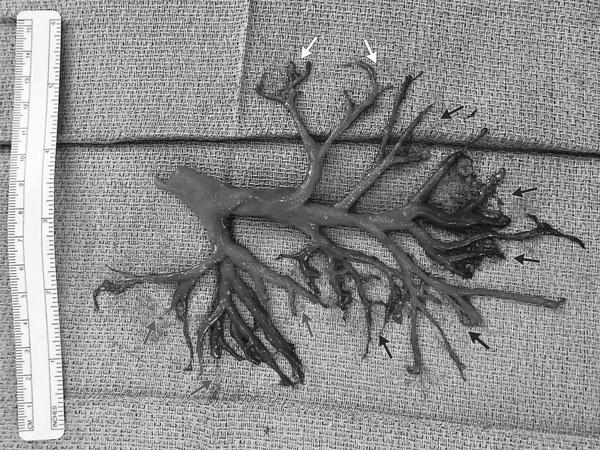 Bức ảnh người đàn ông tử vong vì ho văng phổi”, lý giải của bác sĩ mới gây bất ngờ-1