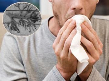 Bức ảnh người đàn ông tử vong vì “ho văng phổi”, lý giải của bác sĩ mới gây bất ngờ