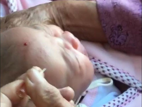 Bác sĩ nói gì về việc dùng kim châm vào đầu trẻ sơ sinh cho chảy máu để con ăn khỏe, nhanh lớn